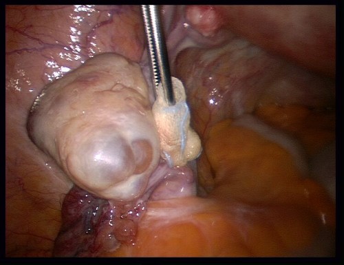 Enlarged Ovarian Cyst